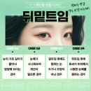 라리성형외과의원 | 뒷트임밑트임후기 날카로운 인상을 바꾸기 위해