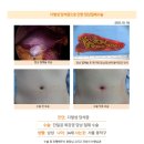 다발성담석증수술후기. 수술 1일차인 오늘 저는 퇴원을 하고 집은 대중교통을 이용할 예정입니다. 이미지