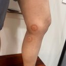 연세항운외과의원 | 용인 하지정맥류 합병증, 혈전으로 생명까지 위험해질 수 있습니다_연세선하지외과 후기