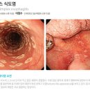 식도염 [esophagitis] 이미지