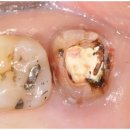 온천부부치과의원 | 춘천치과추천 잇몸 주변에 접착제? 환자분 충격 사례 <공개> (크라운, 신경, 재치료)