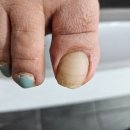 "내일도네일해" 내성발톱 및 문제성 발톱 관리 후기