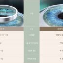고려대학교안경콘택트 | 초고도근시도 가능할까?초고도근시 올레이저라섹 실제 케이스
