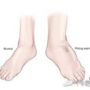 전신 부종 [generalized edema] 이미지