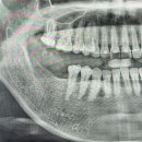 30 | 강남임플란트치과 30대 덴티움 임플란트 시술 후기
