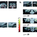 스위스보청기 이미지