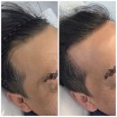 광명 남자 헤어라인 두피문신 후기 인천에서 광명까지 ｜M자 헤어라인 커버, 1차 시술 직후 사례