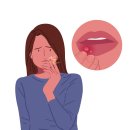 나성동한의원 - 구내염 치료제, 황백黃柏