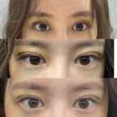 굿모닝창문외과의원 | 쌍수하고 출근한 후기 6일차~8일차 붓기 팝성형외과