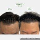 대전두피문신 잘하는 곳 가격 효과 후기 한방정리