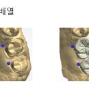 월드치과기공소 네이버블로그