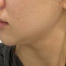 스테이영피부과의원 | 강남역피부과 베러미의원 온다리프팅 3만줄 즉각적인 리프팅 후기