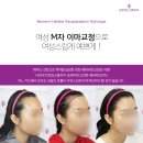 더스케치성형외과의원 | ① 상담편_안면거상 전문 원장님도 추천하는 모앤라인, 40대 여성 모발이식 리얼 후기