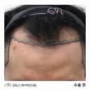 1289 | 인천 모발이식 | 20대 M자 탈모, 1289모낭 이식 후기(10개월 경과)