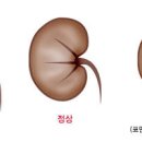 급성 신부전증 만성 신부전 증상 원인 3기 말기 이미지