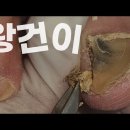 역대급 초대박 왕건이가 나온 발톱... Oddly satisfying fungal toenail 이미지