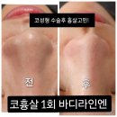 [공지] #비염으로 코 수술 4번째 #코 수술 부작용 흉살 고민! #흉살 관리 후 예뻐진 코 후기 사진