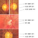 대표적인녹내장종류및녹내장성 시신경 변화와 시야검사 소견 이미지