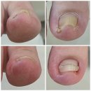 분당-1 | 분당 내돈내산 내성발톱 관리후기, 1회만에 통증 싹 가라앉은 솔직 후기