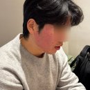 차고치는남자 | 광주 여드름흉터 치료 | 율안침 2회차 광천동 한의원 추천 | 내돈내산 후기