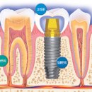 임플란트 모르면 고생 이미지