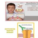 중증 근무력증 , 그 원인은? 이미지