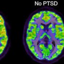 외상 후 스트레스 장애 (PTSD 뜻) 증상 진단 치료 이미지