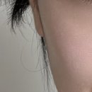 부산 동래 마리뷰티 문제성 피부관리 에어 플라즈마관리 후기