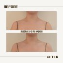 GS25 논현한영점 | 신논현역피부관리 캐롤뷰티 스페셜 바디관리 후기 승모근 내리기