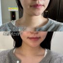 망포1차아이파크 | 망포역 피부관리 리프팅 후기 | 더엘에스테틱 V핏 비리본리프팅 예신관리 가격, 관리 전후