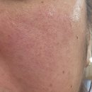 이선생뷰티 | 무너진 피부에 다시 희망을, 안성에스테틱 화사로아뷰티 안성점 수화강테라피 후기