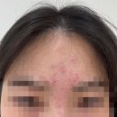 대구여드름흉터 반월당 흉터피부과 한의원 리얼 후기