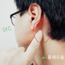 귀 뒤 멍울 귀뒤에 혹 부음 피지낭종 원인 왼쪽 오른쪽 귀뒤쪽 통증 어떤 이유일까 이미지