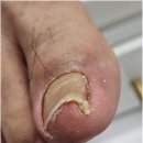 리오풋케어 | 통증 없이 교정하는 내성발톱 관리! 청계천 리오풋케어 리얼후기