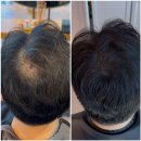 보나단헤어엔카페 | 장전동 구서동 남자 정수리 커버 두피 톤 보정으로 자연스럽게 달라진 후기