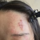 광명한방병원 | 고등학생 대상포진… 너무 속상했던 이야기 (광명면력한방병원 입원 후기)