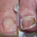 무주읍191 | 무주무좀발톱 복원 잘하는 곳 풋&amp;네일 페디크루 무주점