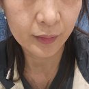 중앙부 | 신사역피부과 이브타이탄 중앙부 줄이는방법 축소 리프팅 리얼후기