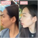 순한의원 | 닥터손유나의원 코셀라리프팅 4회차 내돈내산 후기