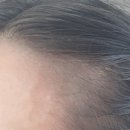 몽드랩 셀띠크30  삼성 | [서울] 헤어라인 커버 smp 시술 찐후기 몽드랩 삼성점