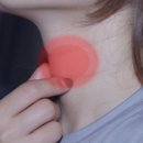 ‘급성 목감기’ 치료 후 나은 20대女...며칠 뒤 응급 입원까지 한 까닭은? 이미지