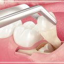 평촌사랑니, &#39;이것&#39; 몰라서 안면마비 생깁니다.(통증/병원 선택 TIP)