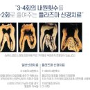 이도튼튼치과의원 | 신경치료 한번에 끝낼 순 없나요? 이도튼튼치과에서 알려드립니다.