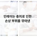 연신내치과의원 | 연신내치과 인레이는 충치로 인한 손상 부위를 깎아낸