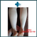 디렉스모터스 | 능평리 헬스 (헬스/PT/다이어트/스피닝/GX/기구필라테스) - 부종 , 부종케어 후기