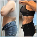 강동천호복싱다이어트 | 천호 비만클리닉 복부 지방추출주사 후기, 상체비만 타파!(다이어트 약 처방,가격,부작용)