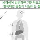 뇌경색 , 절대 놓치면 안 되는 초기 증상 5가지 이미지