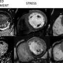 Stress Perfusion Imaging Using Cardiovascular Magnetic Resonance: A Review 이미지