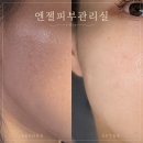 엔젤 | 대전 피부관리 월평동 여드름관리 엔젤피부관리실 솔직후기
