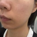 강남역 | 피부탄력 시술 소프웨이브 가격 효과 통증 부작용,써마지 비교 강남역 피부과 후기